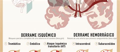 traduction stroke|stroke en español.